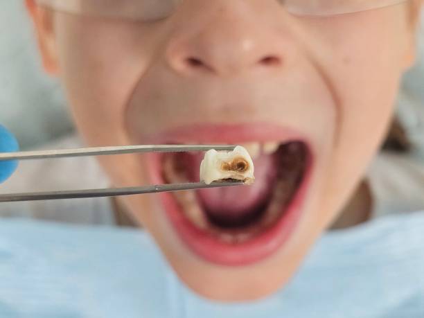 Best Root Canal Emergency Dentist  in Woodstock, GA